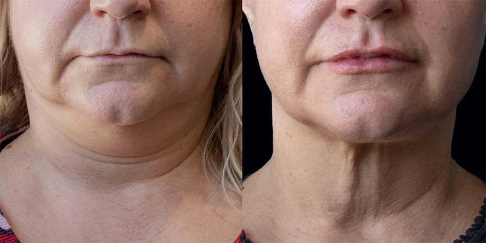 Renuvion Before & After
