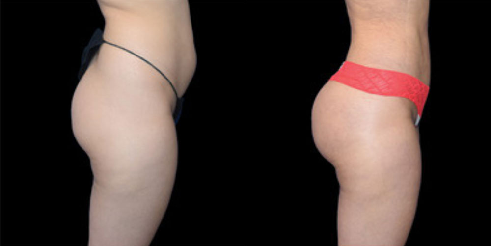 Renuvion Before & After