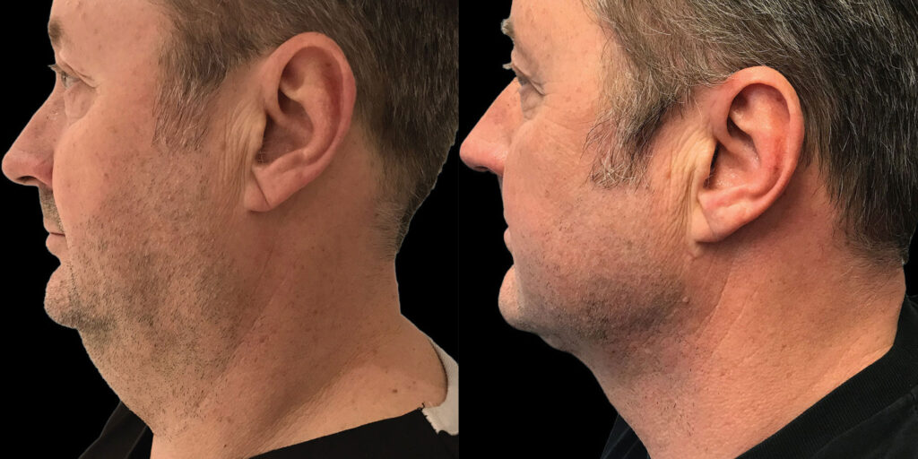 ba Lipo then Renuvion Neck Male
