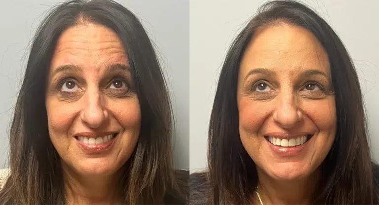 Botox Before and After photo by Kerin MedSpa Laser Center in Tuckahoe NY Botox Before and After photo by Kerin MedSpa Laser Center in Tuckahoe NY