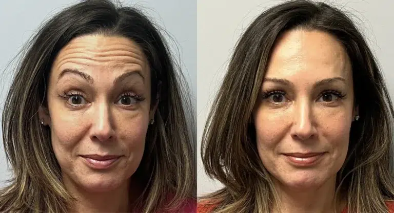 Botox Before and After photo by Kerin MedSpa Laser Center in Tuckahoe NY Botox Before and After photo by Kerin MedSpa Laser Center in Tuckahoe NY