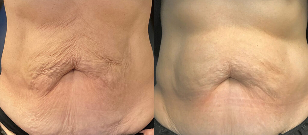 Morpheus RF Before and After photo by Kerin MedSpa & Laser Center in Tuckahoe, NY