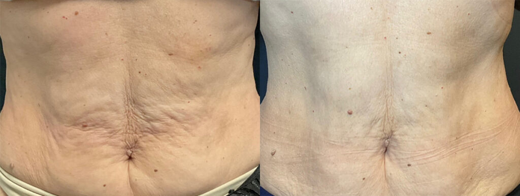 Morpheus RF Before and After photo by Kerin MedSpa & Laser Center in Tuckahoe, NY