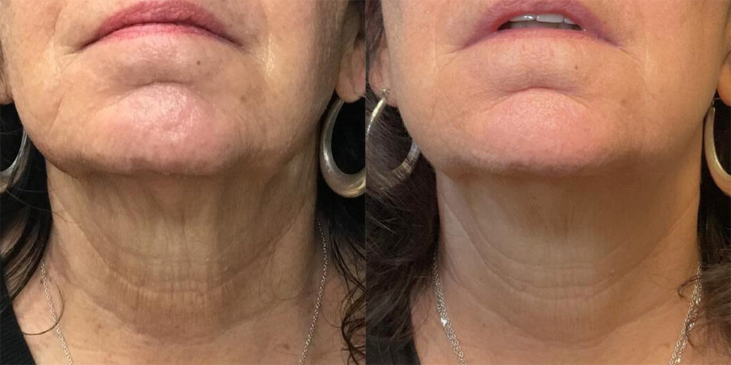 Morpheus RF Before and After photo by Kerin MedSpa & Laser Center in Tuckahoe, NY