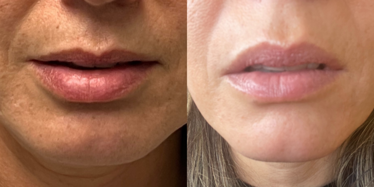 Botox Lip Flip Before and After Botox Lip Flip Before and After