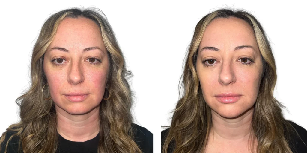 Cheek, Jaw, Chin Filler Before and After photo by Kerin MedSpa & Laser Center in Tuckahoe, NY