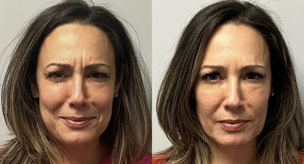 Botox Before and After photo by Kerin MedSpa Laser Center in Tuckahoe NY