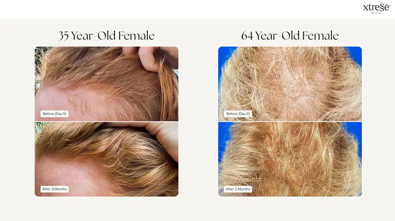 Xtressé before and after
