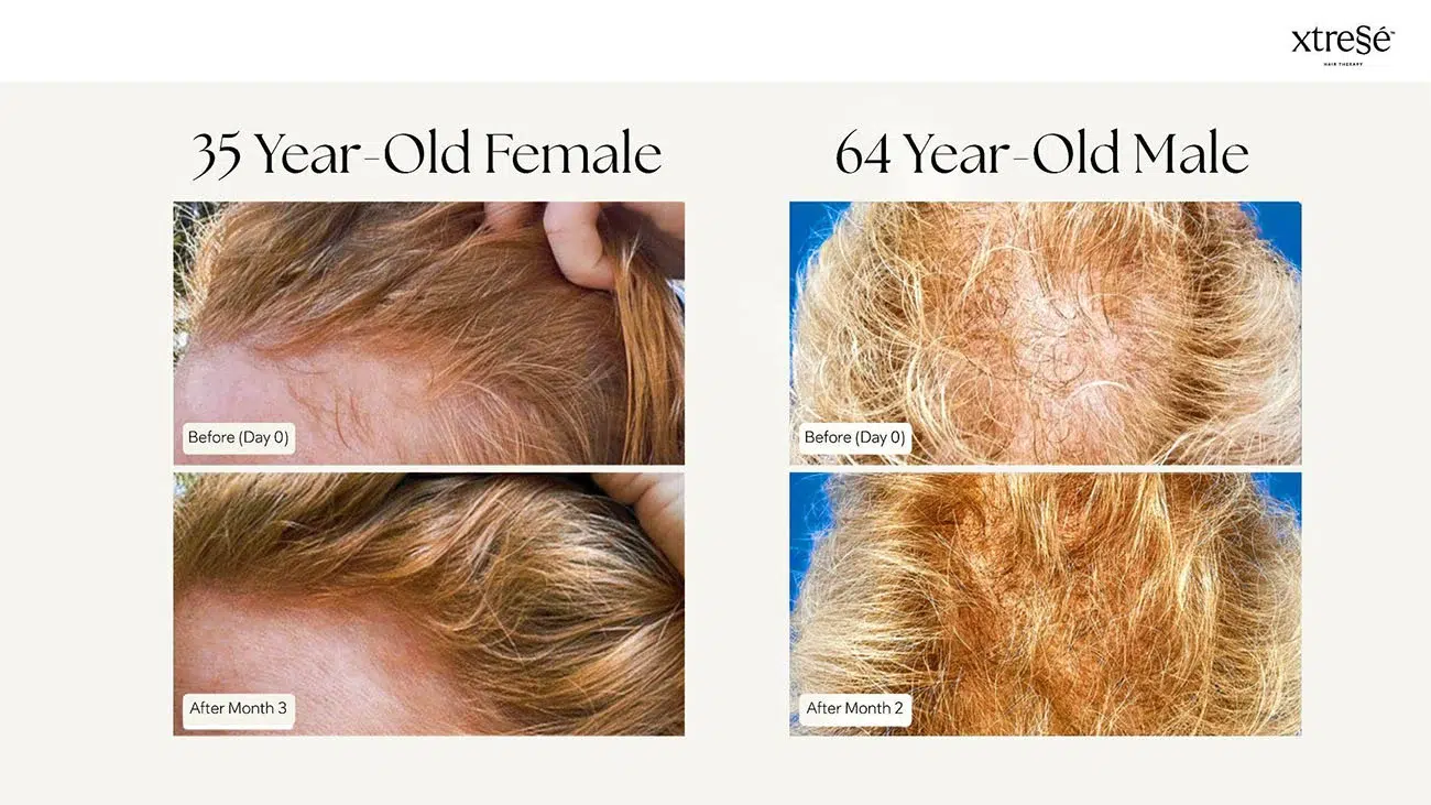 Xtressé before and after