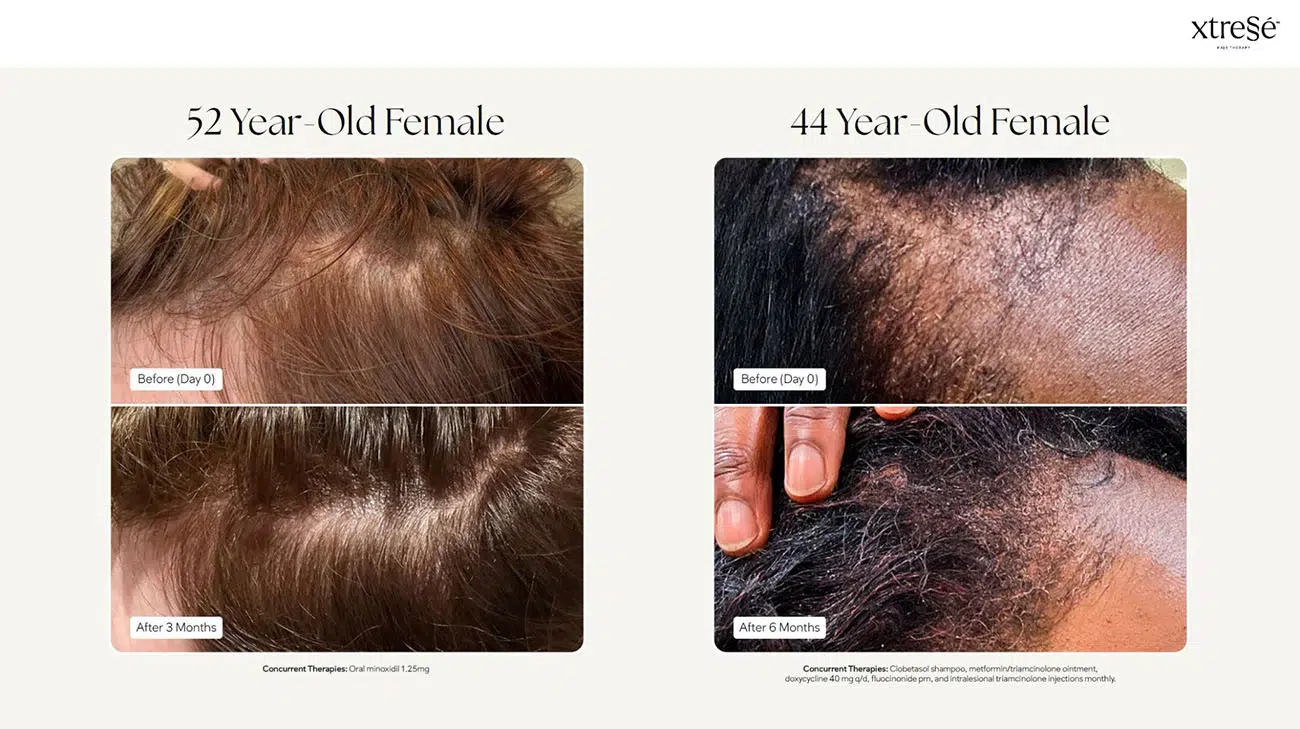 Xtressé before and after