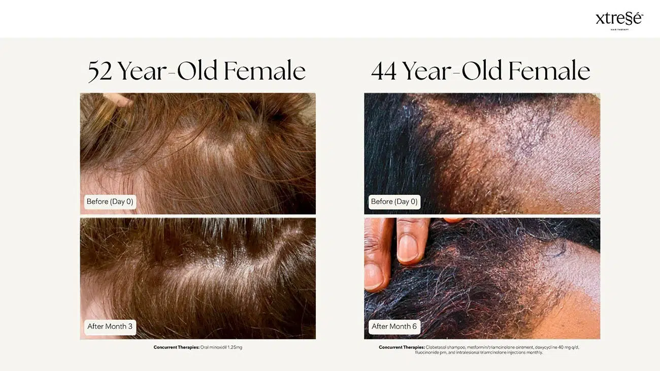 Xtressé before and after