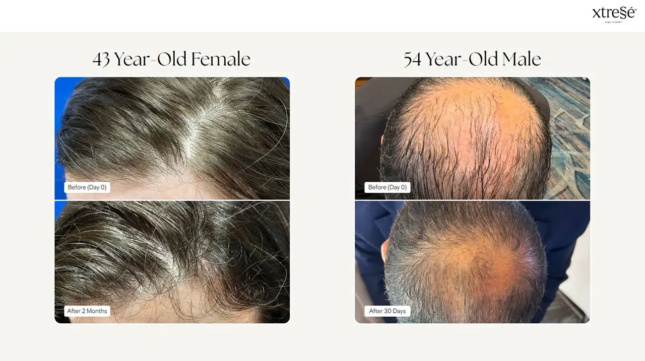 Xtressé before and after
