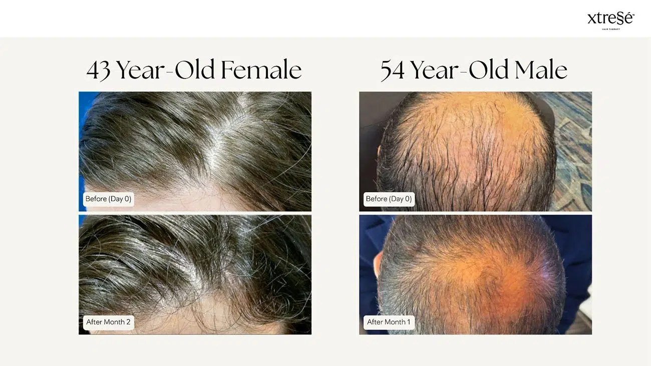 Xtressé before and after