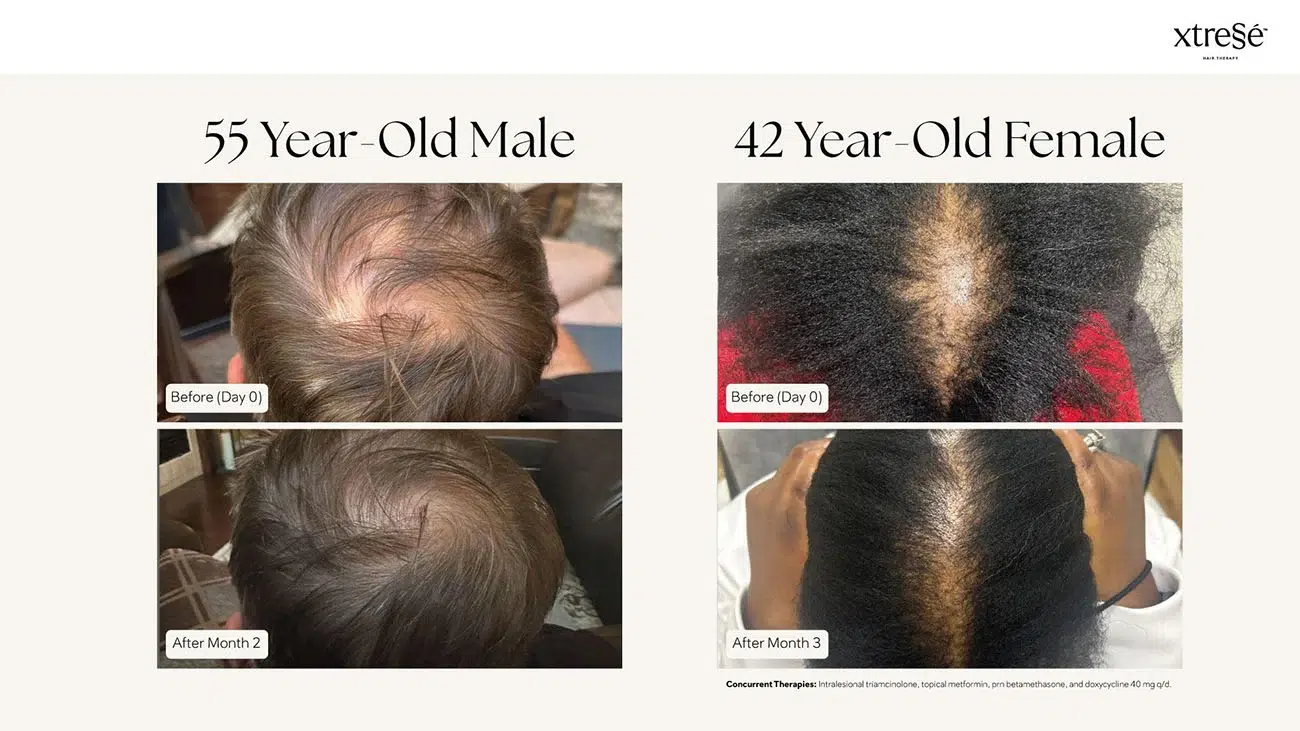 Xtressé before and after